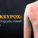 Monkeypox: Everything you need to know